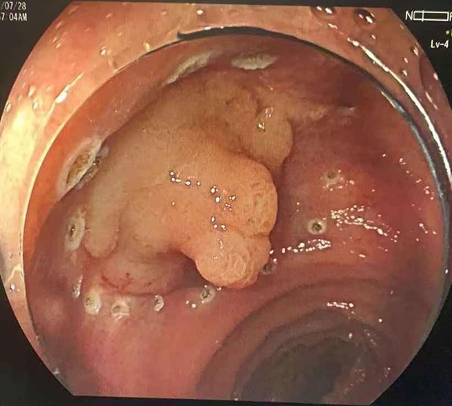 巨大直肠侧向发育型肿瘤（LST）患者实施内镜下粘膜剥离术(ESD)