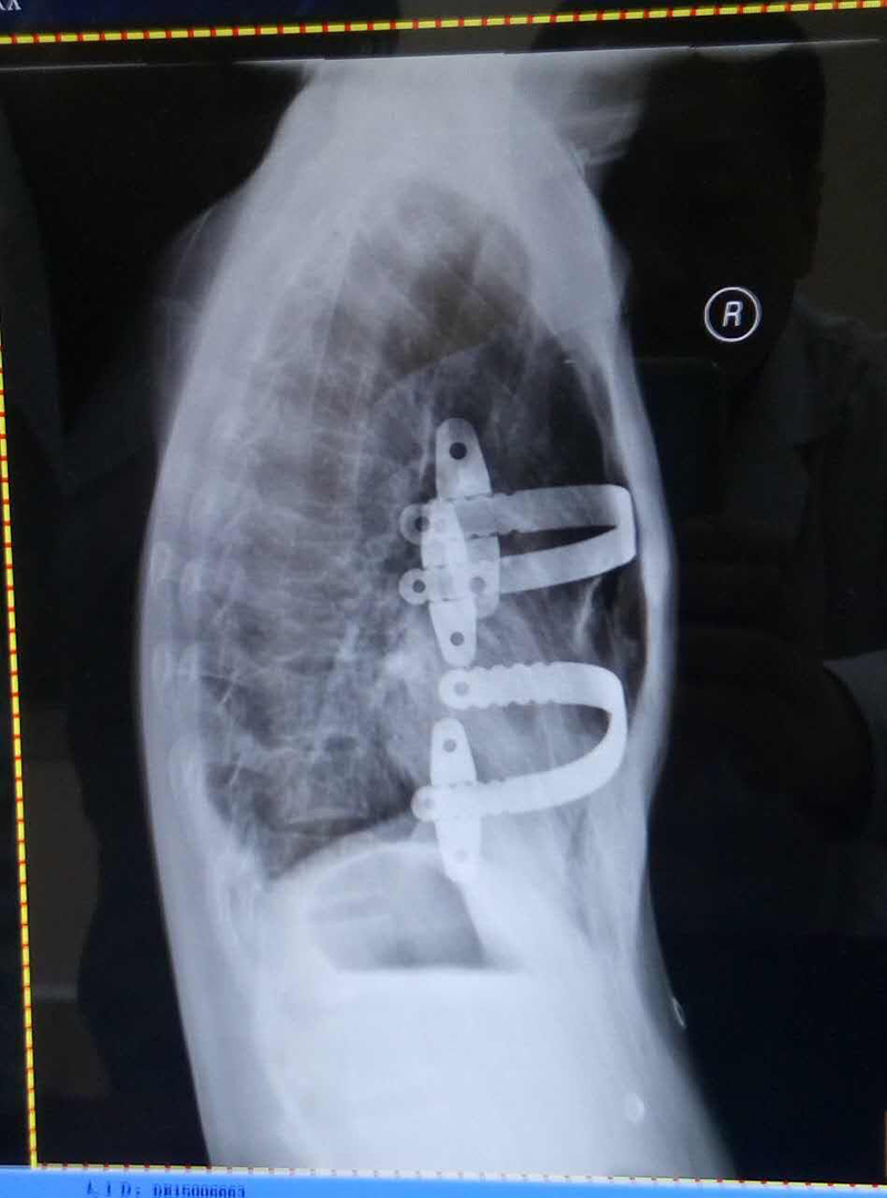 我院胸外科成功开展首例漏斗胸微创矫正手术