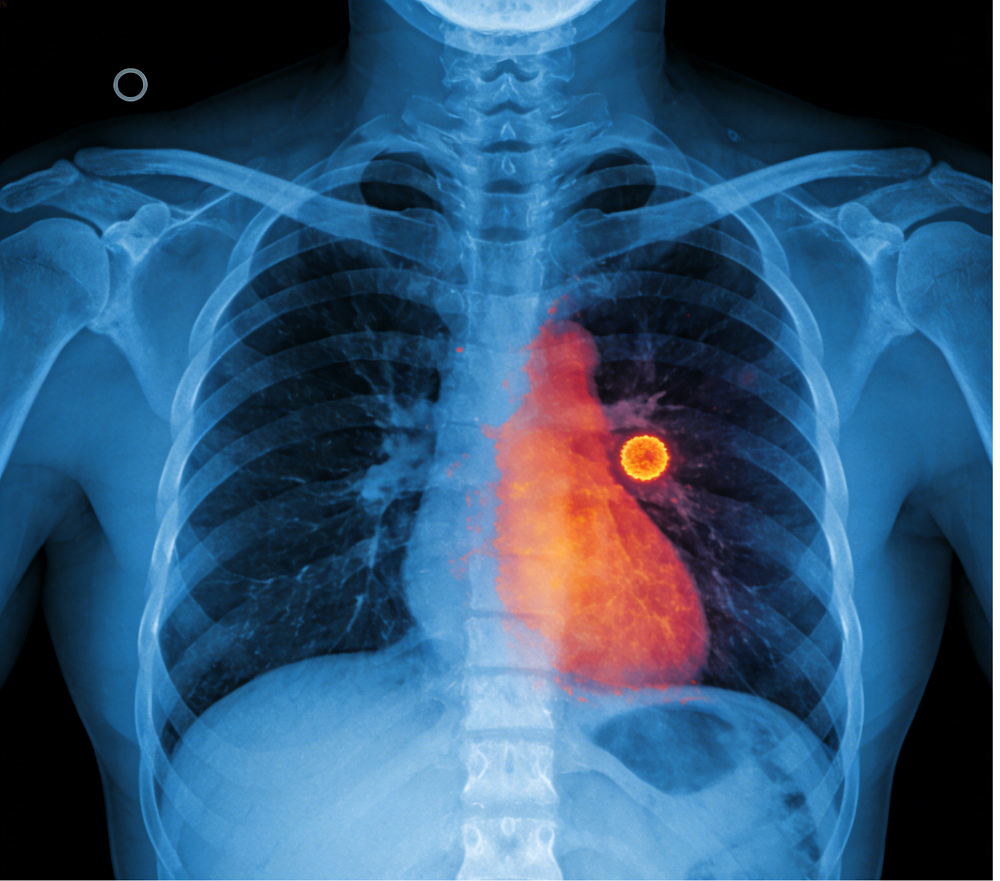 体检发现肺结节，会癌变吗？别慌！这几点你一定要知道