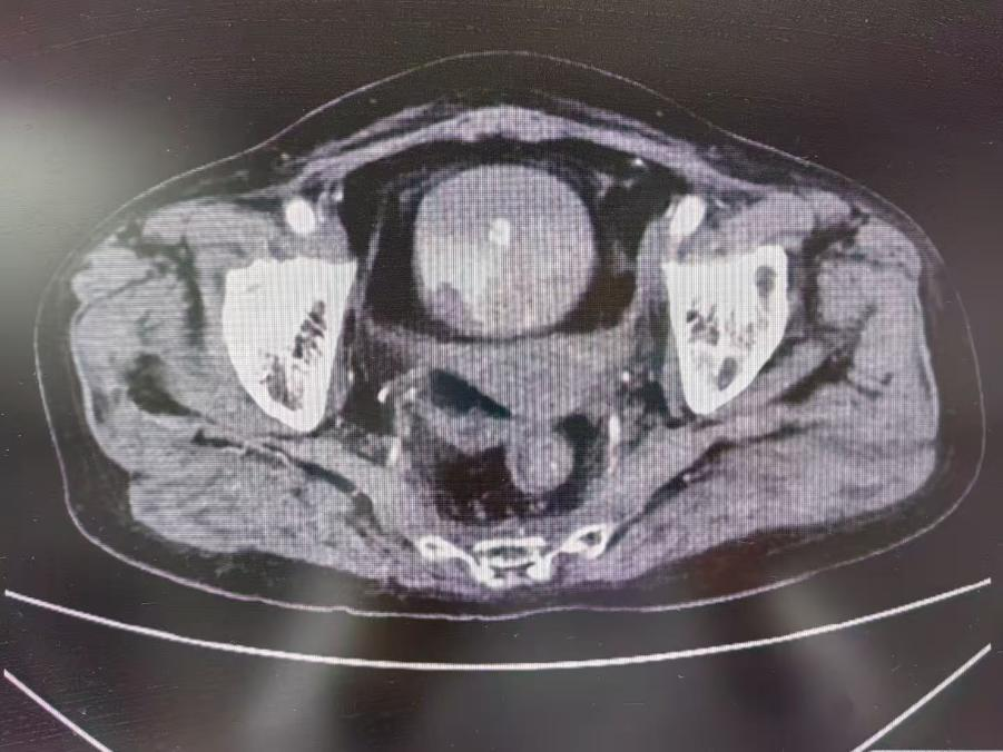 从输血无效到“立竿见影”，介入治疗如何终结致命性出血