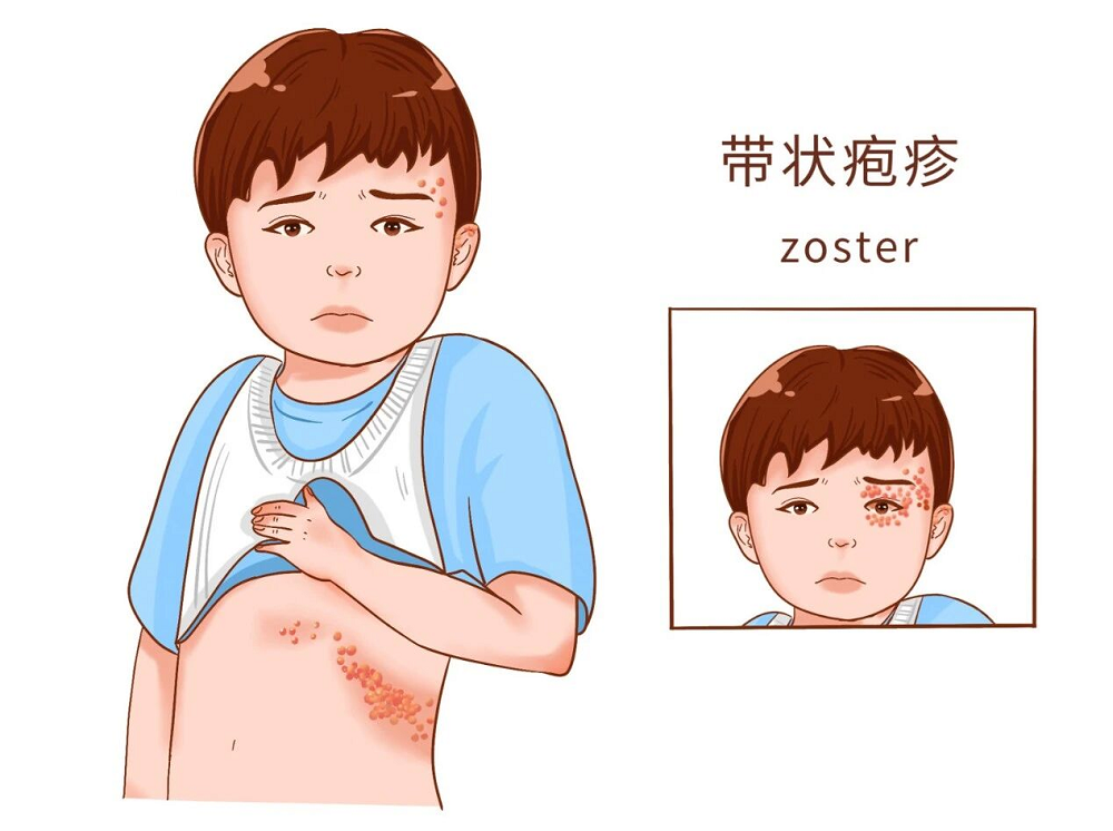 一次感染，终生携带！别让"缠腰龙"缠上你